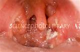 Tonsillitis Stock Image M270 0320 Science Photo Library