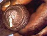 Male Gonorrhea Infection With Goop Flowing Out Of Penis Opening