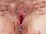 Perio Bleeding On Period C Girl Virgin Pussy Bl Virgin Girl Bleeding