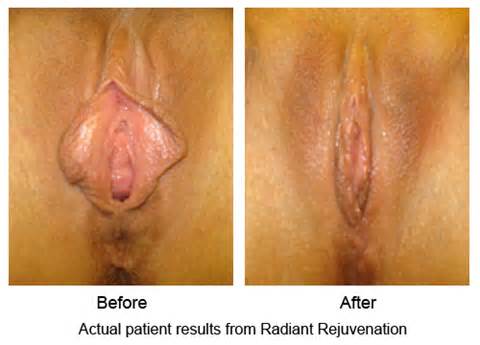 The Photos Show Vaginal Rejuvenation A Correction For Loose Vagina