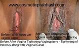 Vagina Surgery Delhi India Tightening Rejuvenation Vaginoplasty