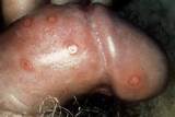 Male Herpes Simplex Virus 2 Sti Penis Lesions