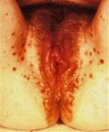 Female Primary Syphilis Infectious Lesions