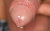 The Clap Gonorrhea Infection Showing Dripping Penile Juice