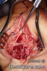 Open Palm Surgery Best Gore