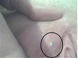 Bump On Vaginal Bump Vaginal Bumps Vaginal Bumps On Vaginal