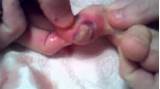 Part 2 GIANT PIMPLE CYST POP ON TOE PART 2 The Popping YouTube