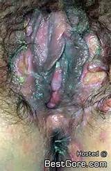 Blue Waffle Disease Best Gore