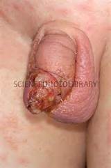 Infected Circumcision Wound Stock Image C004 2399 Science Photo