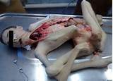 Girl Pussy Autopsy