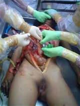Rape Victim Autopsy13 Jpg