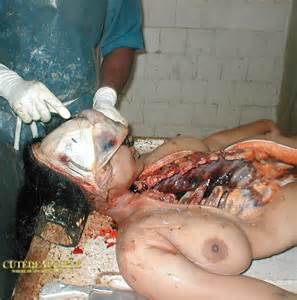 Girl Pussy Autopsy