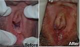Vagina Tightening Plastic Surgery Thailand Cosmetic Surgery