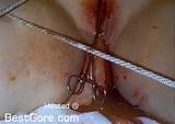 Surgical Tools Used To Perform Labiaplasty On A Dumb Woman Best Gore