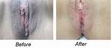And After Photos Vaginal Bleaching Tips For Safe Skin Lightening