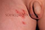 Shingles Rash Stock Image M260 0298 Science Photo Library