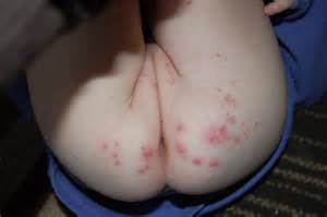 My Daughter Is 3 Yo For Over A Year She Has Had A Rash On