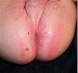 Bloody Diaper Rash Help Ingender Com Ass Rash Photo Picture