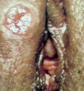 Female Primary Syphilis Infection Chancre Near Vagina