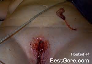 Bloodied Vagina Of A Woman Undergoing Labiaplasty Best Gore