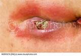 Infected Pressure Sore Stock Photos Royalty Free Royalty Free