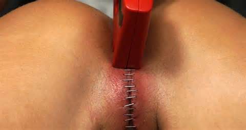 Pussy Sewn Stapler Free BDSM Sewing Porn Masochism Pics