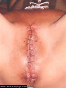 Pussy Sewn Shut BDSM
