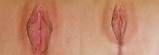 Vaginoplasty Rejuvenation Of The Vagina Female Cosmetic Genital