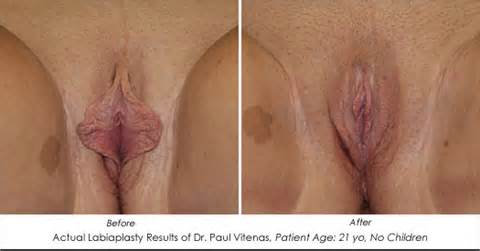 Actual Before And After Photos Of Vaginal Rejuvenation