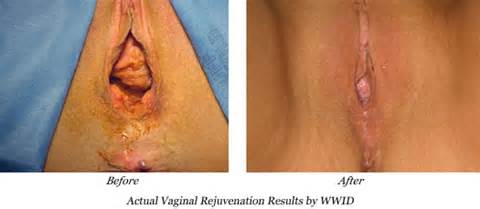 Vaginal Opening After Birth Healthy Vaginal Opening Photograph Of