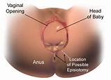 Vagina Before And After Childbirth Before And After