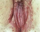 Bleeding Vagina Yeast Infection Porn Pictures Archive