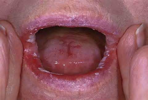 Yeast Infection Of The Mouth Oral Thrush