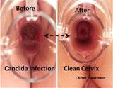 Candida Infection Queensway Gynaecology Clinic UK London