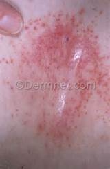 Cutaneous Candidiasis Causes Candida Skin Lesions Pictures