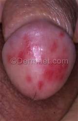 Candida Penis Photo