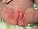 Yeast Infection In Children