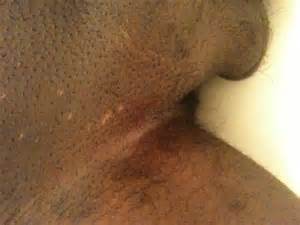 Bumps On Pubic Hair Since April Electric Buzz Shaving Bumps